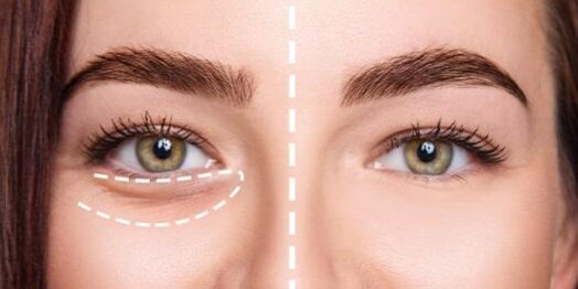 Gözaltı Işık Dolgusu