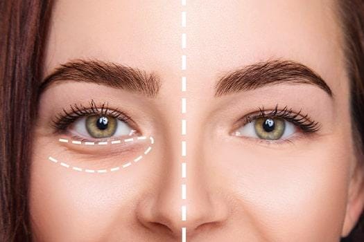 Gözaltı Işık Dolgusu