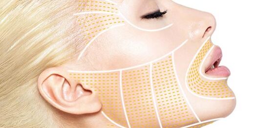 Örümcek ağı Mezoterapi