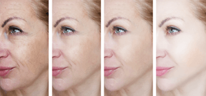 Anti-Aging Mezoterapi