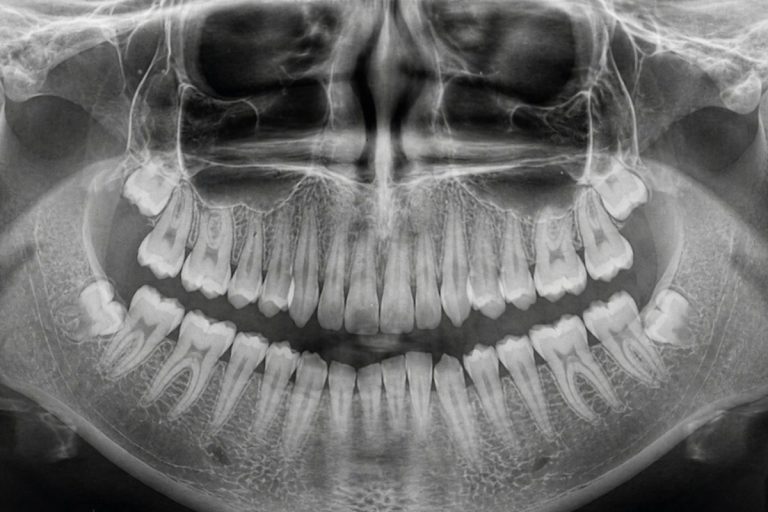 Masseter Botoks